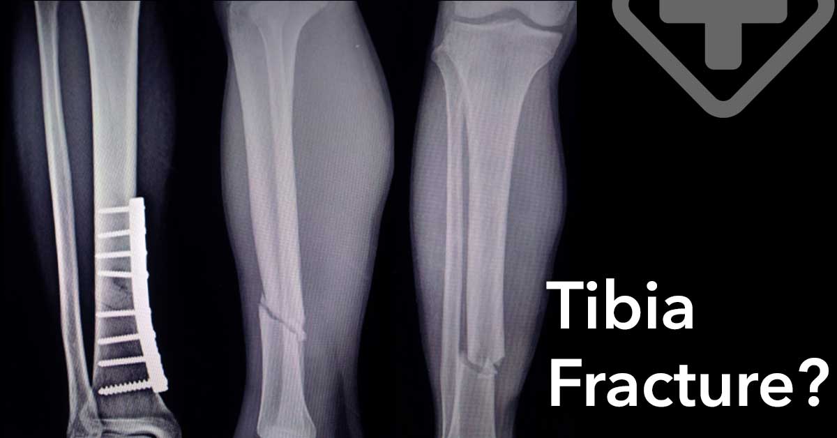 Tibia Fracture